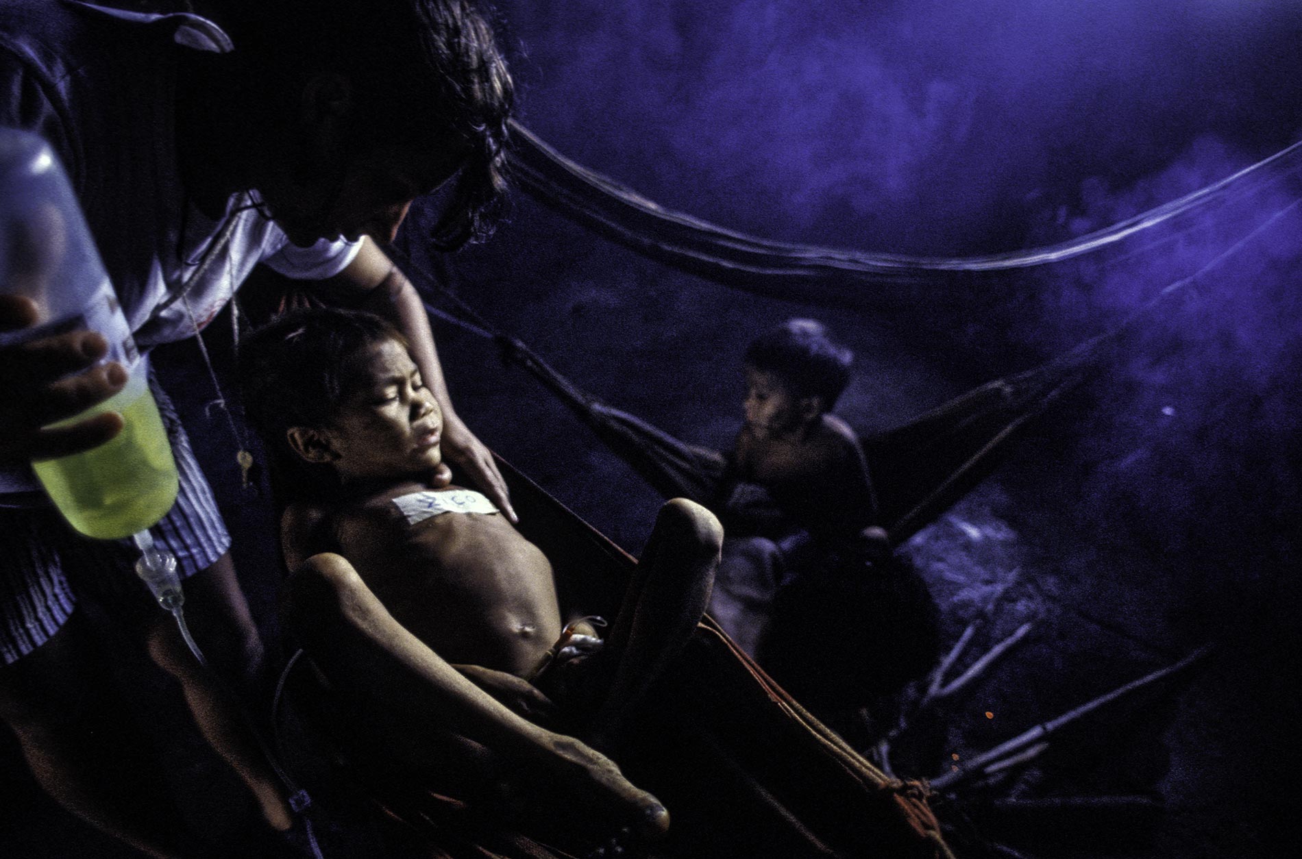 Yanomami child malnutrition malaria