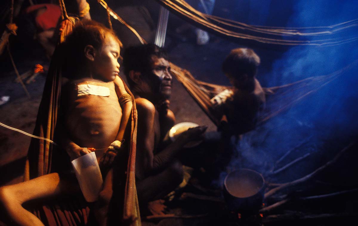 Yanomami malnourished child malaria